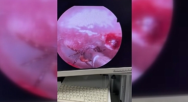 Kulak ağrısıyla hastaneye gitti, kulağından kene çıktı