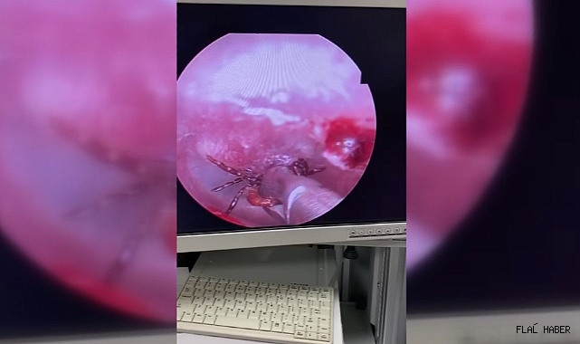 Kulak ağrısıyla hastaneye gitti, kulağından kene çıktı