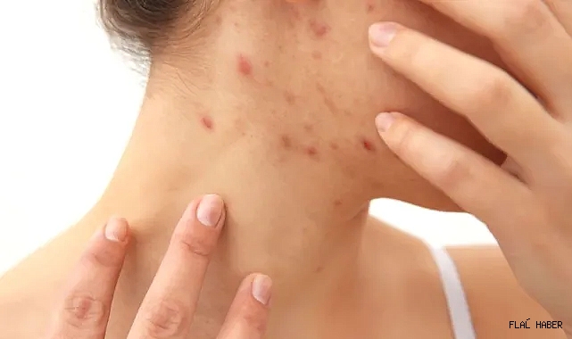 DERMATOLOJİ UZMANI “HASTALIĞINBULAŞABİLMESİ İÇİN EN AZ 15-20 DAKİKALIK BİR TEMAS GEREKİR”