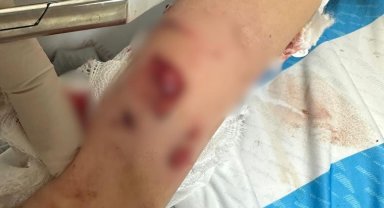 Sevdiği köpeğin saldırısına uğrayan 12 yaşındaki çocuk yaralandı