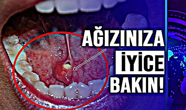 Sessiz tehlike ağızda gizleniyor