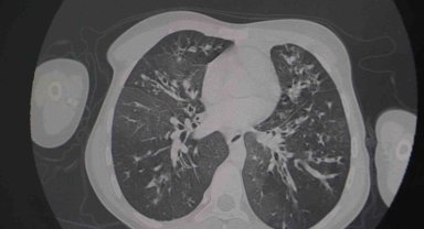 Uzmanı, kistik fibrozis hastalığında erken tanının önemine dikkat çekti