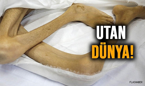 İSRAİL'İN SALDIRILARI ALTINDAKİ GAZZE'DE BİR ÇOCUK DAHA AÇLIKTAN HAYATINI KAYBETTİ!