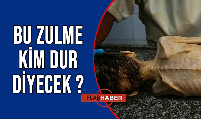 GAZZE'DE BİR ÇOCUK DAHA "AÇLIKTAN" ÖLDÜ!