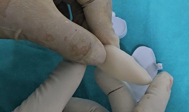 Osmaniye'de ilk kez 3D yazıcı tekniğiyle kafatası ameliyatı