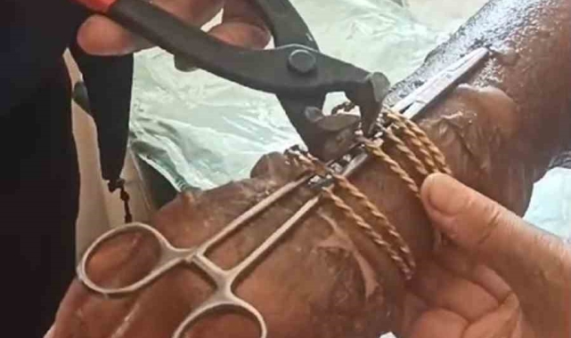 Kolu yanan kadının bilezikleri kesilerek çıkartıldı