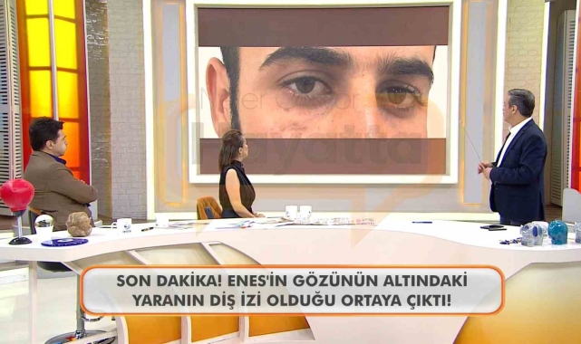 Canlı yayında Enes Güran'ın gözünün altındaki diş izine dikkat çekildi