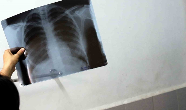 Bel ağrılarınız iltihaplı romatizma olabilir