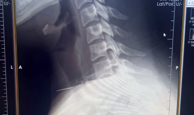 Kadının boğazına saplanan iğne ameliyatla çıkarıldı