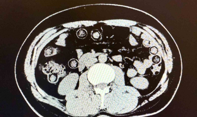 Muş'ta midelerinden 928 gram uyuşturucu çıkan 2 İranlı tutuklandı