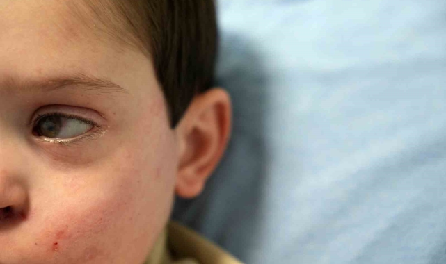 Yüzünün sol tarafı felç olan 4 yaşındaki Burak'a 'akupunktur' tedavisi umut oldu
