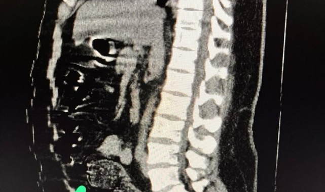 Bağırsaklarında 3 adet uyuşturucu dolu kapsül çıkan İranlı şahıs tutuklandı
