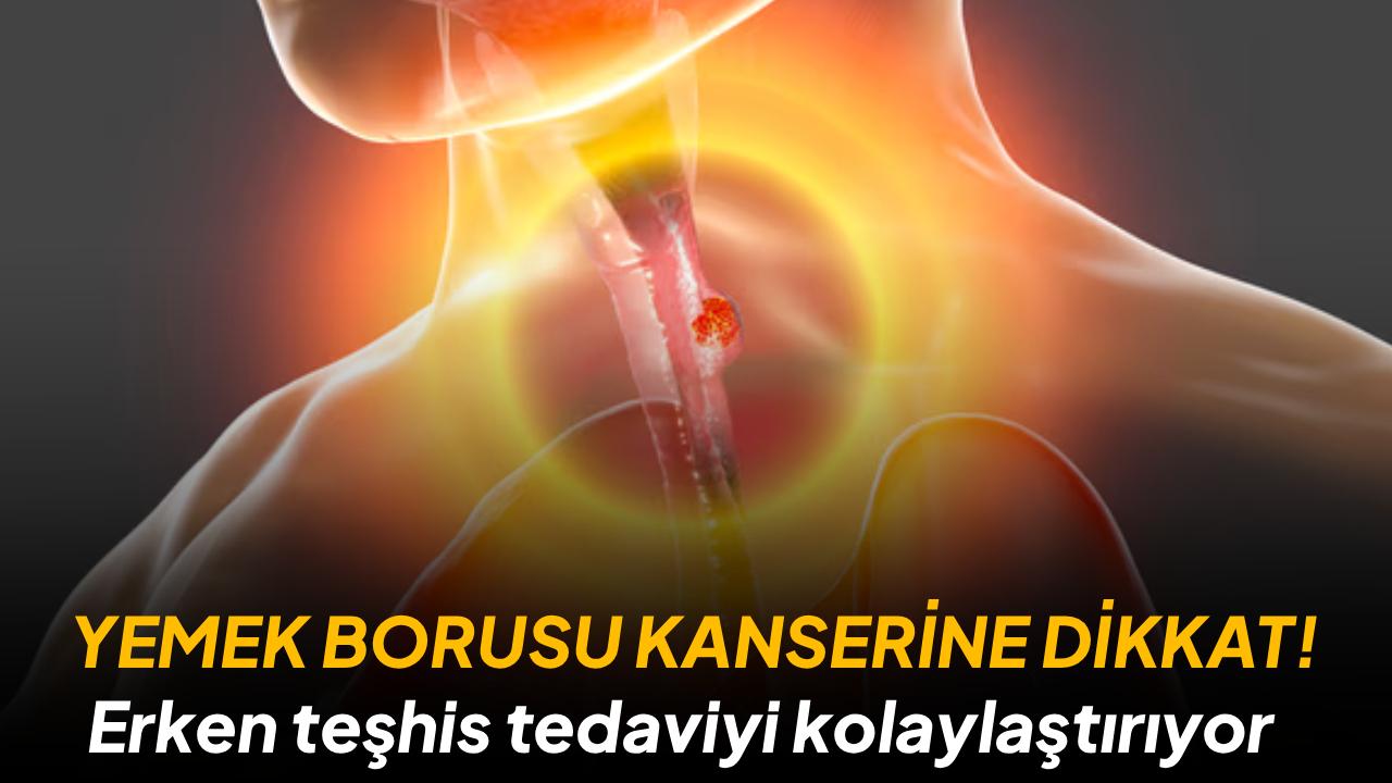 Yemek borusu kanserlerinde erken teşhis tedaviyi kolaylaştırıyor