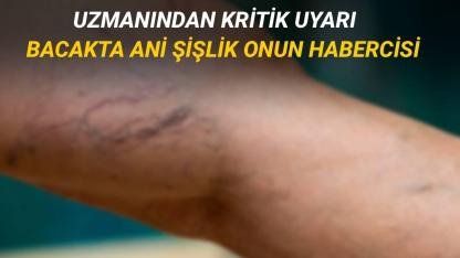 Bacakta ve kolda ani tek taraflı şişlik toplardamar pıhtısının habercisi